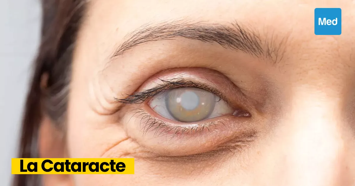 Comprendre la Cataracte : Symptômes, Causes, Traitement et Prévention